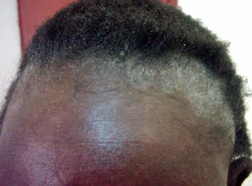 How To Get Rid of Dandruff for Black People 201407